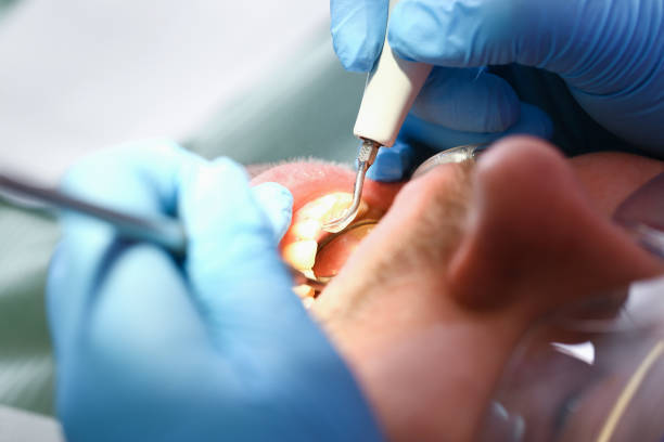 Best Emergency Tooth Extraction in Wheaton, MD