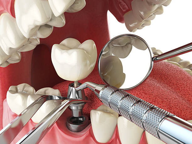 Best Emergency Root Canal Treatment in Wheaton, MD